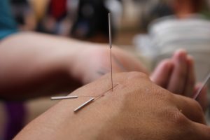 Akupunkturnadeln in einem HandrÃ¼cken